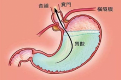 【胃肠治疗呼市哪家医院好】胃经常反酸，容易引起5个“大麻烦”，告诉你3种胃酸治疗方法