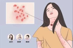 沈阳得了牛皮癣怎么办？治疗牛皮癣好的医院在哪里？